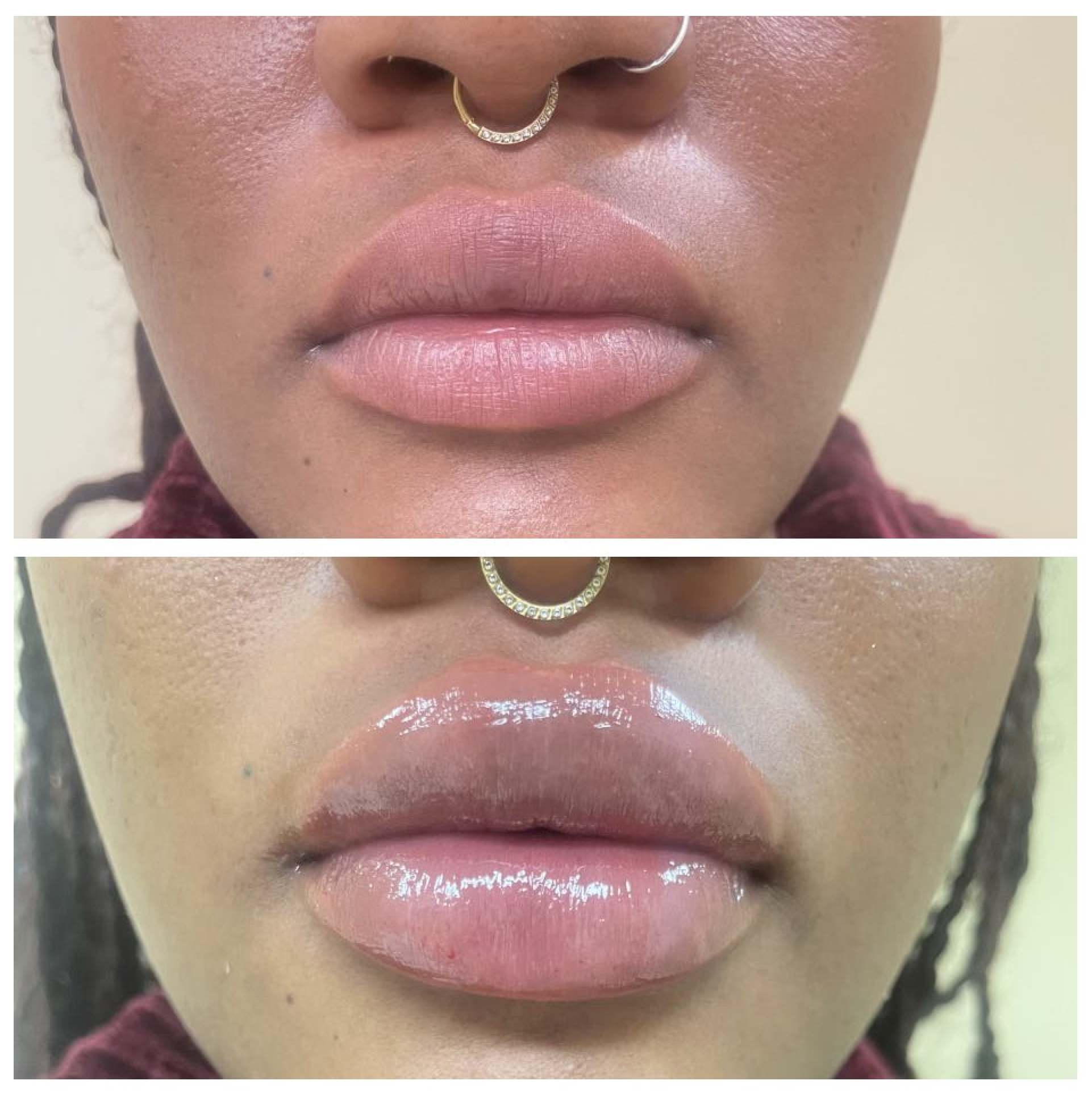 Lip Filler